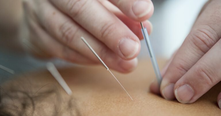 Dry needling: o que é, para que serve e como funciona